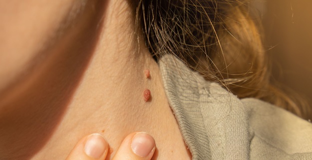 How To Remove Skin Tags Naturally?